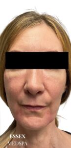 After Image: Dermal Fillers for Under-Eye Hollows and Cheeks