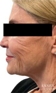 After Image: Derma PRP With Microtox