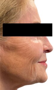 After Image: Derma PRP With Microtox