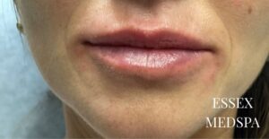 After Image: Lip Filler