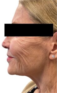 Before Image: Derma PRP With Microtox