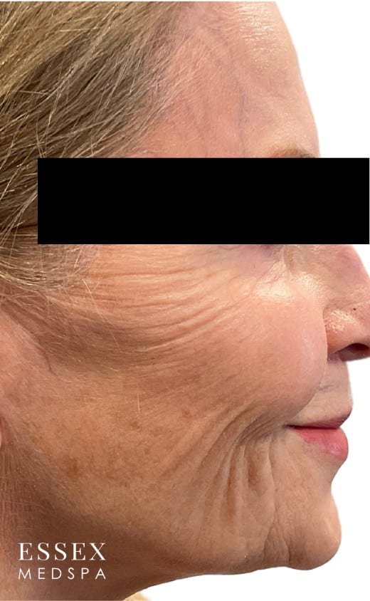 Before Image: Derma PRP With Microtox - right-side
