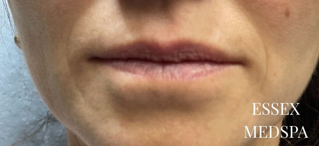 Before Image: Lip Filler - front