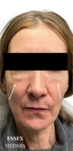 Before Image: Dermal Fillers for Under-Eye Hollows and Cheeks