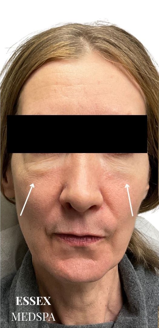Before Image: Dermal Fillers for Under-Eye Hollows and Cheeks - front