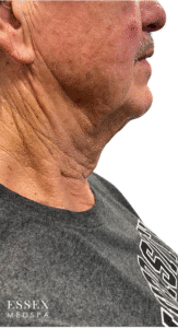 Before Image: Derma PRP with Morpheus8 for Neck