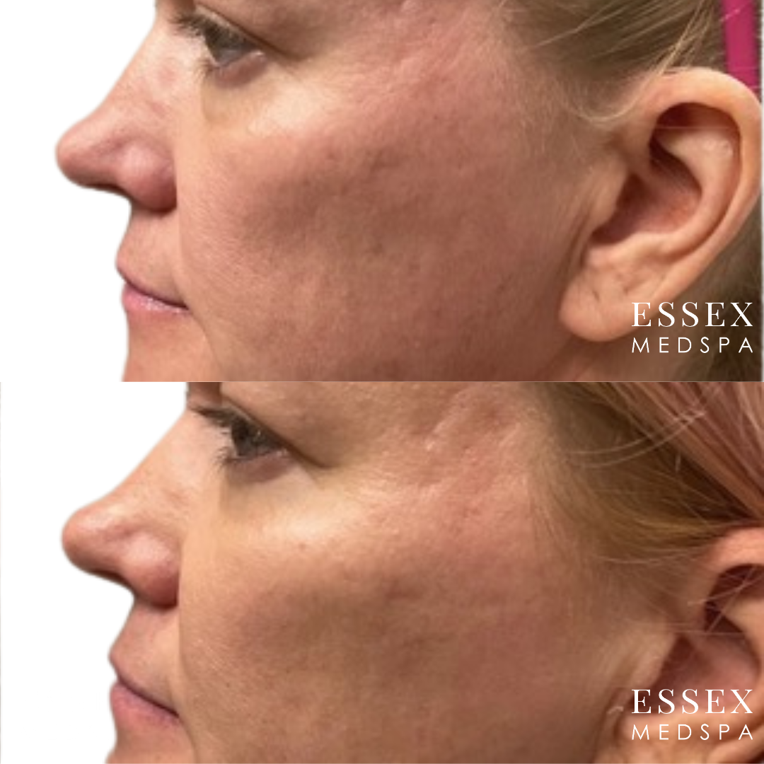 Dermal Filler Schenker