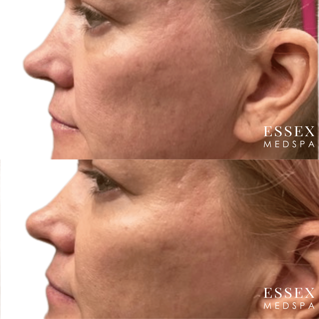 Dermal Filler Schenker