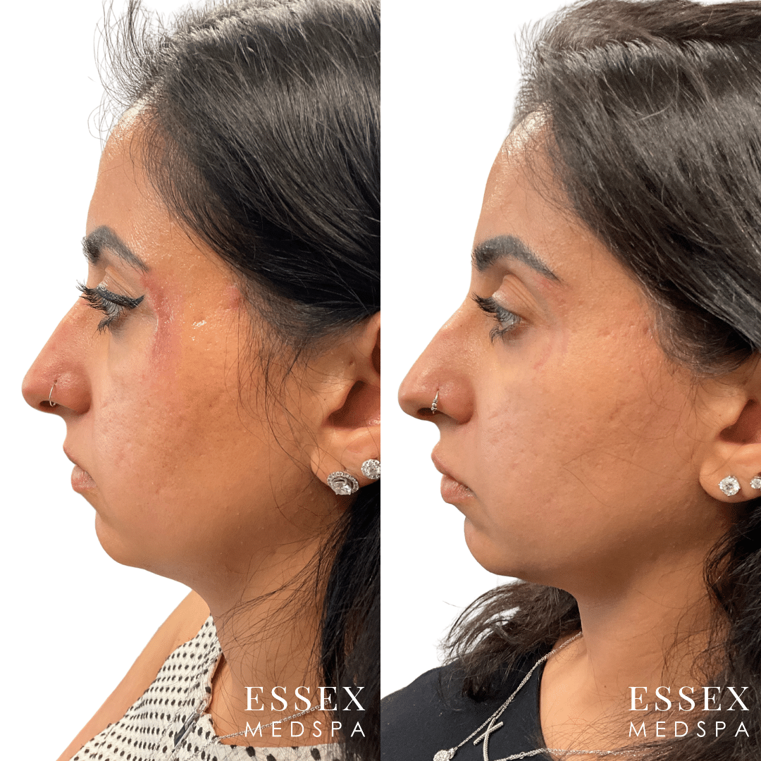 Kaur, Morpheus8 and PRP for scar reduction