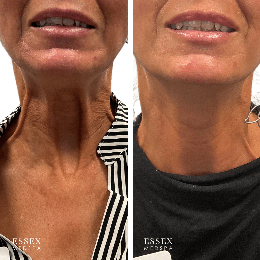 L. Doty, Nefertiti Neck Lift