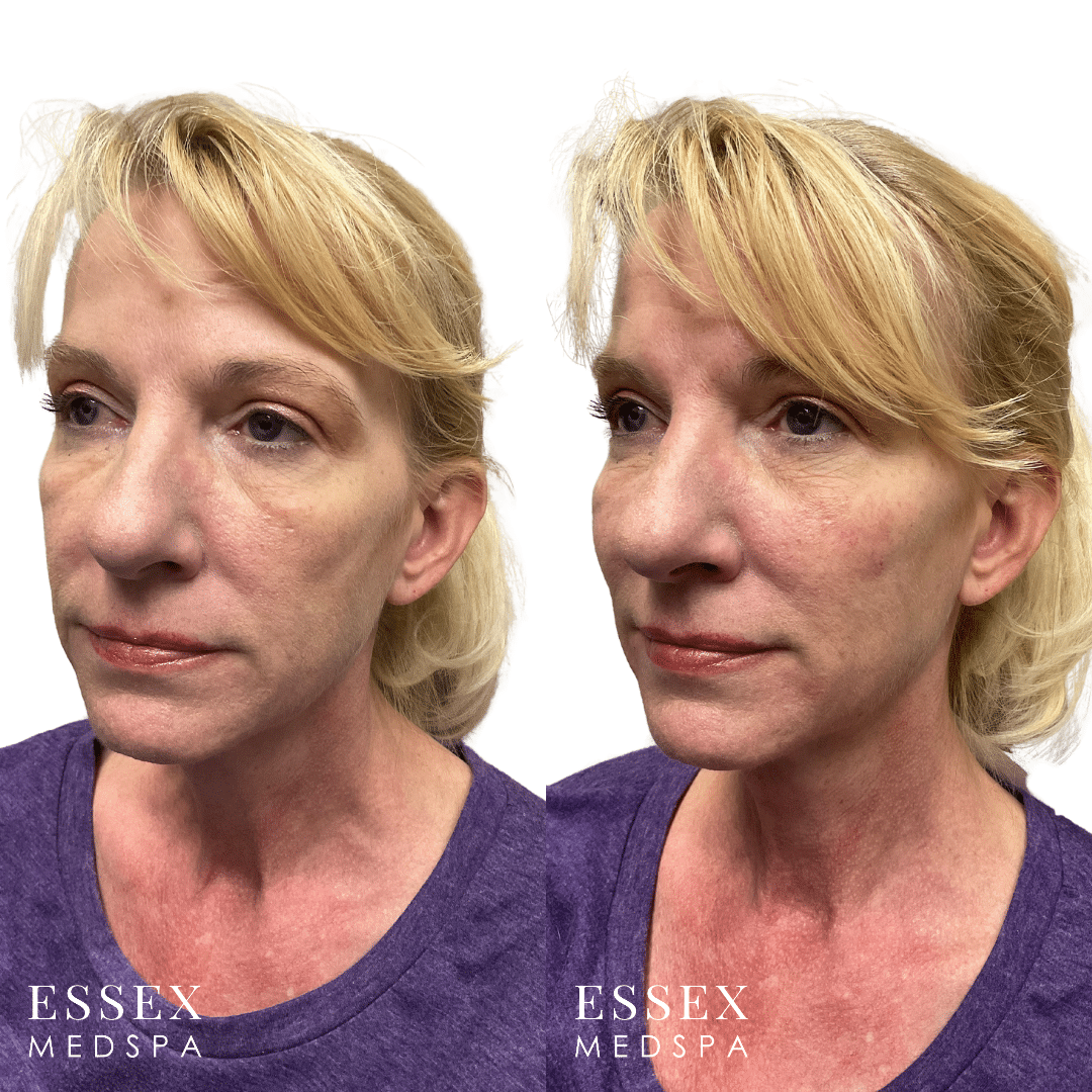 M. Johnson, Sculptra