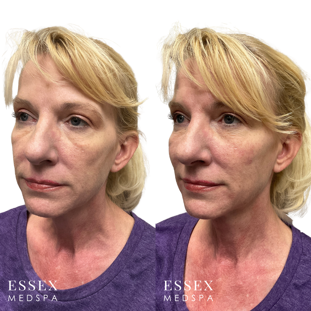 M. Johnson, Sculptra