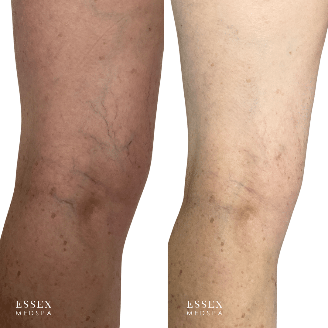 Markert, Schlerotherapy