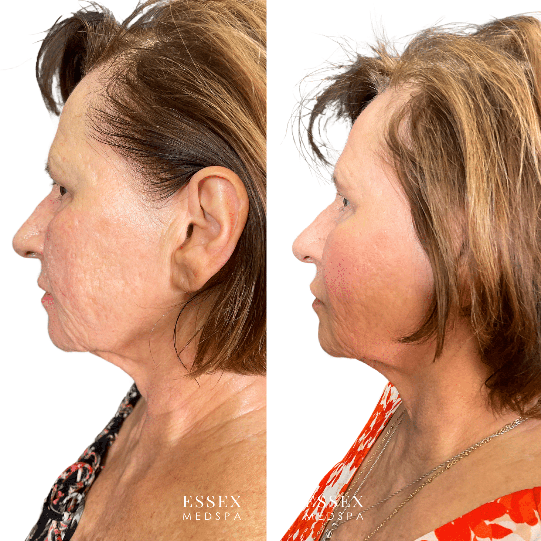 Nault Adams, Morpheus8