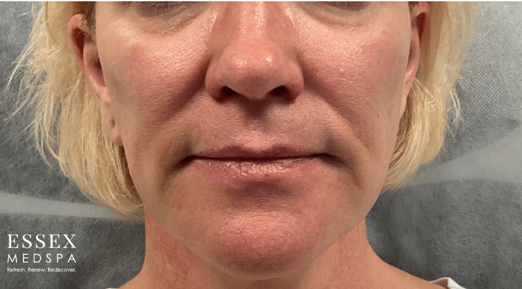 Before Image: Sculptra - front