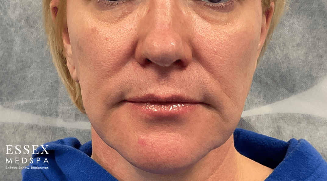 After Image: Sculptra - front