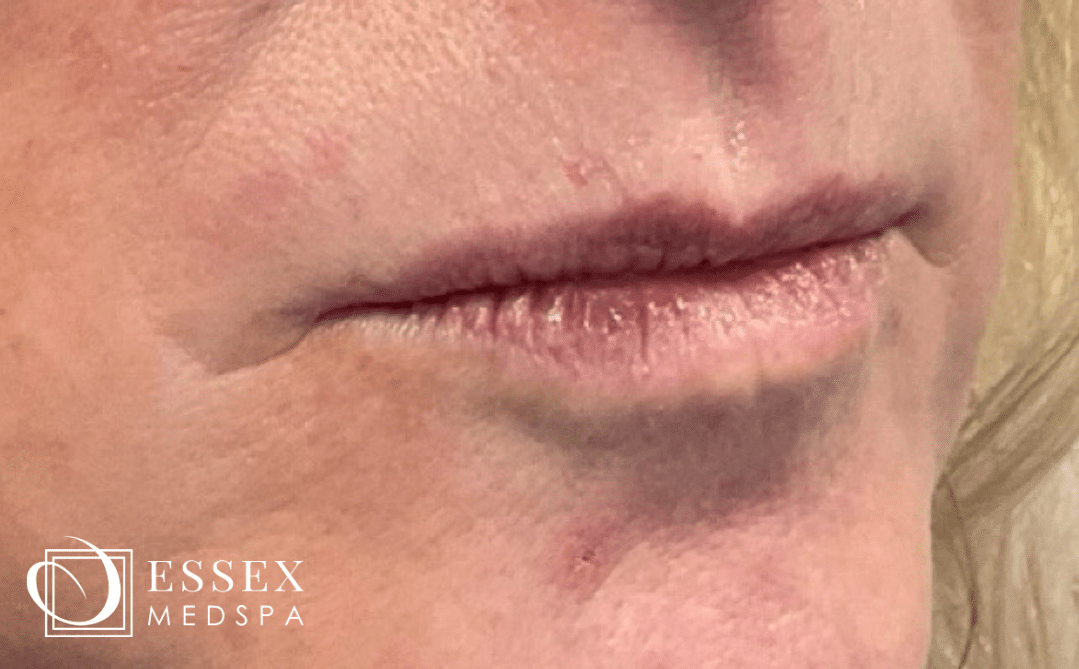 Before Image: Lip Filler - right-front-oblique