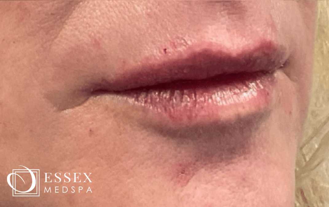 After Image: Lip Filler - right-front-oblique