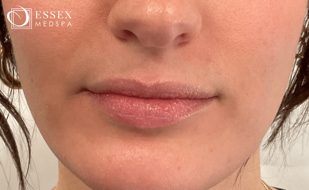 Before Image: Lip Filler - front