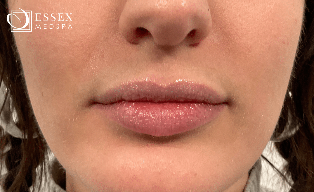 After Image: Lip Filler - front