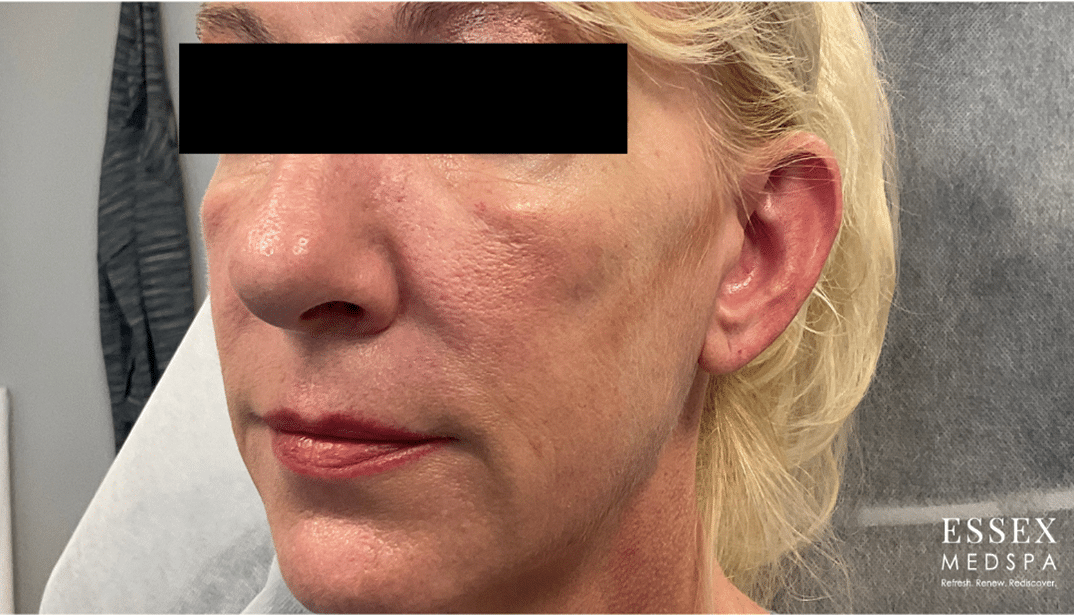 After Image: Sculptra - front