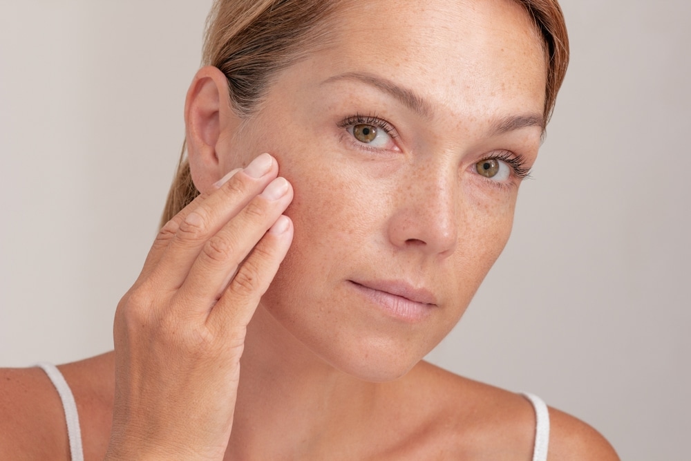 Woman with melasma on her face in Littleton, CO