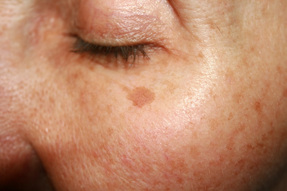 Woman's face with age spots in Littleton, CO
